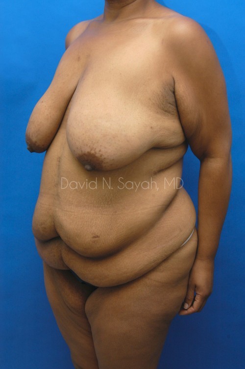 Body Lift Before and After | Sayah Institute