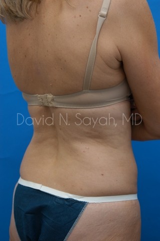 Body Lift Before and After | Sayah Institute