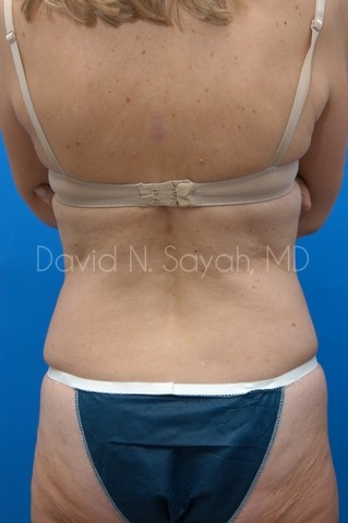 Body Lift Before and After | Sayah Institute