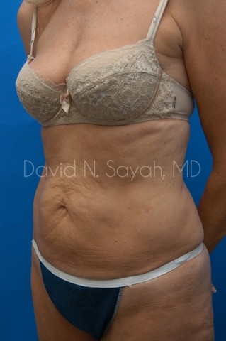 Body Lift Before and After | Sayah Institute