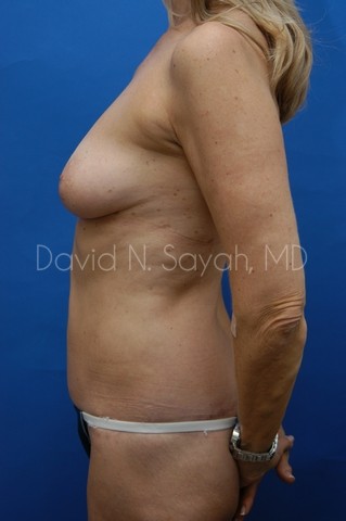 Body Lift Before and After | Sayah Institute