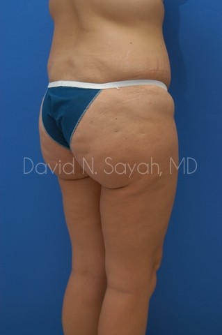 Body Lift Before and After | Sayah Institute