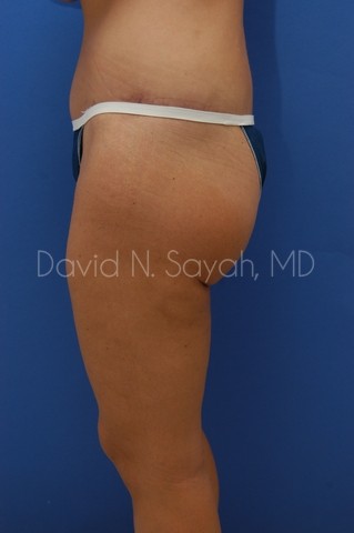Body Lift Before and After | Sayah Institute