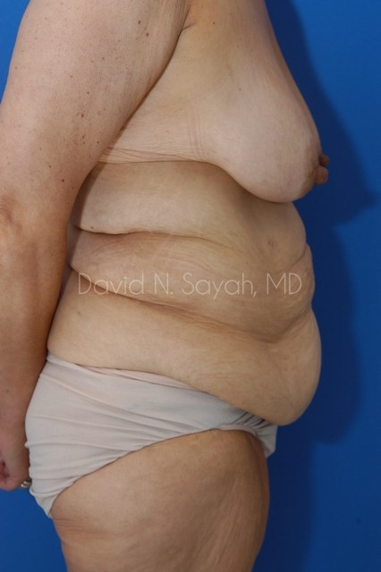 Body Lift Before and After | Sayah Institute