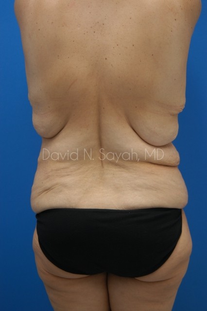 Body Lift Before and After | Sayah Institute