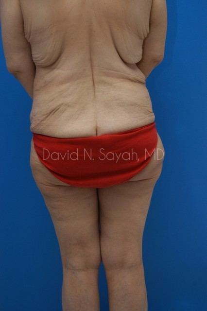 Body Lift Before and After | Sayah Institute