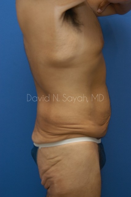 Body Lift Before and After | Sayah Institute