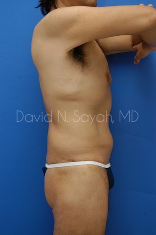 Body Lift Before and After | Sayah Institute