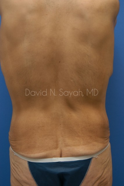 Body Lift Before and After | Sayah Institute