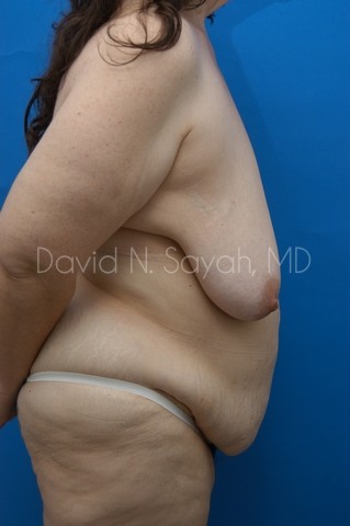 Body Lift Before and After | Sayah Institute