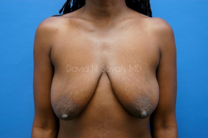 Breast Augmentation And Mastopexy Before and After | Sayah Institute