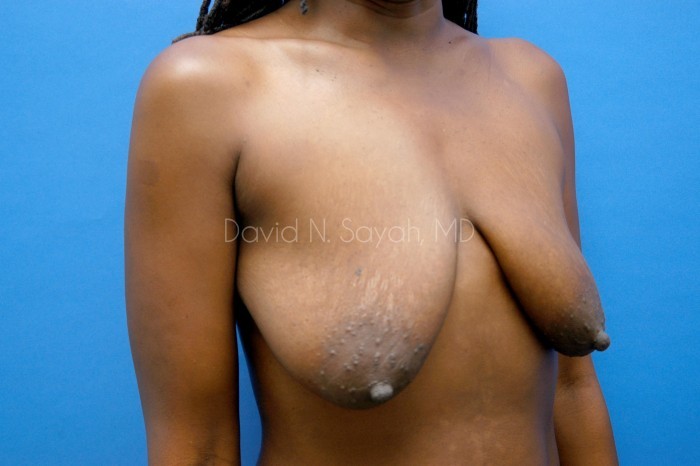 Breast Augmentation And Mastopexy Before and After | Sayah Institute