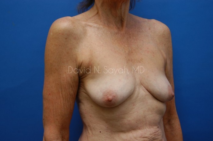 Breast Augmentation And Mastopexy Before and After | Sayah Institute