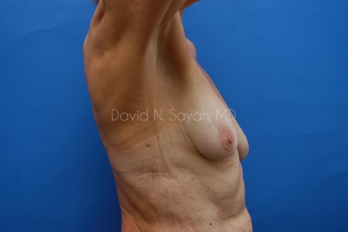 Breast Augmentation And Mastopexy Before and After | Sayah Institute