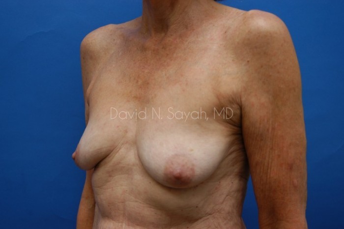 Breast Augmentation And Mastopexy Before and After | Sayah Institute