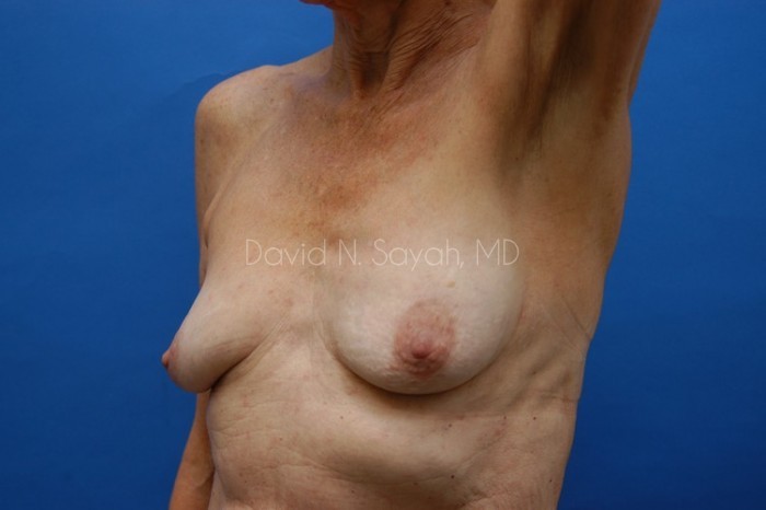 Breast Augmentation And Mastopexy Before and After | Sayah Institute