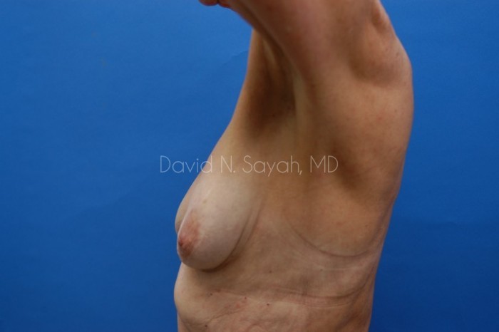 Breast Augmentation And Mastopexy Before and After | Sayah Institute