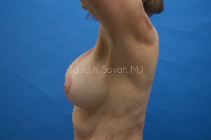 Breast Augmentation And Mastopexy Before and After | Sayah Institute