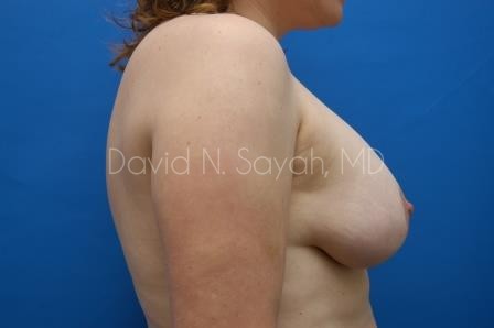 Breast Augmentation And Mastopexy Before and After | Sayah Institute