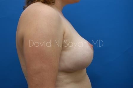 Breast Augmentation And Mastopexy Before and After | Sayah Institute