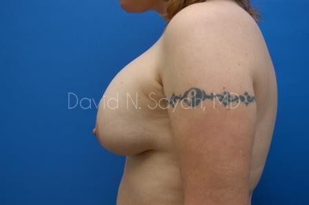 Breast Augmentation And Mastopexy Before and After | Sayah Institute