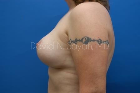 Breast Augmentation And Mastopexy Before and After | Sayah Institute