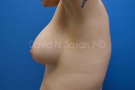 Breast Augmentation And Mastopexy Before and After | Sayah Institute