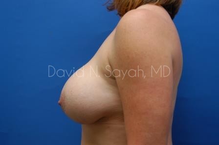 Breast Augmentation And Mastopexy Before and After | Sayah Institute