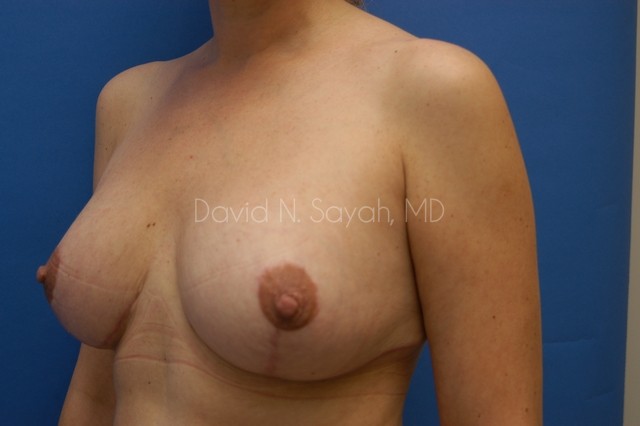 Breast Augmentation And Mastopexy Before and After | Sayah Institute
