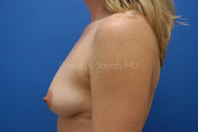 Breast Augmentation And Mastopexy Before and After | Sayah Institute