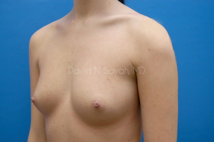 Breast Augmentation Before and After | Sayah Institute
