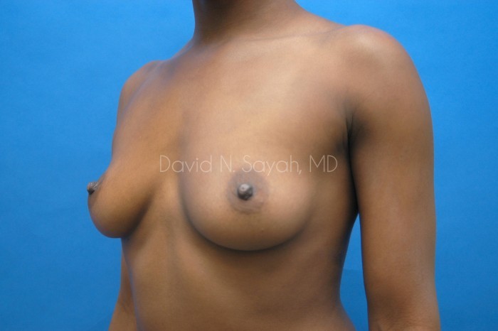Breast Augmentation Before and After | Sayah Institute