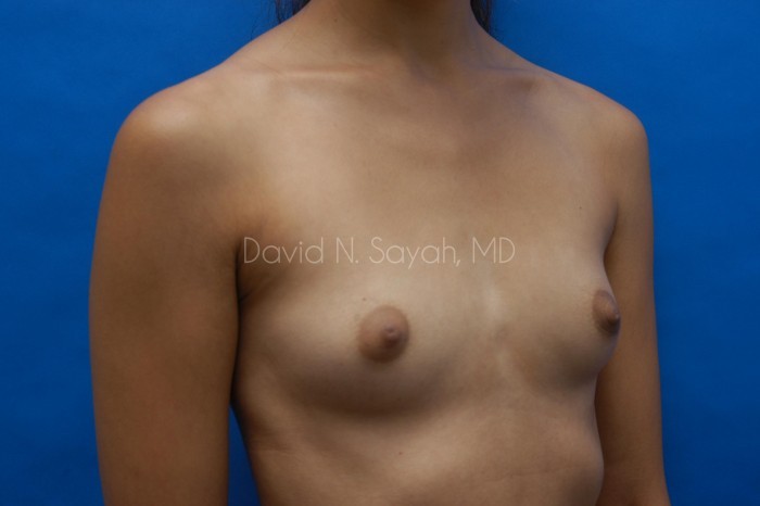 Breast Augmentation Before and After | Sayah Institute