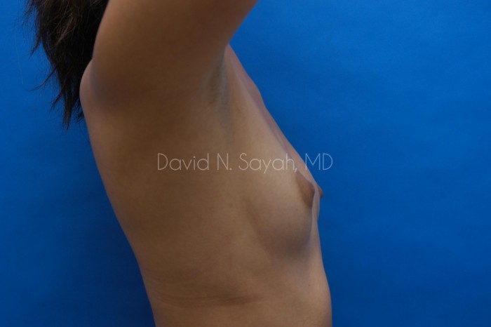 Breast Augmentation Before and After | Sayah Institute