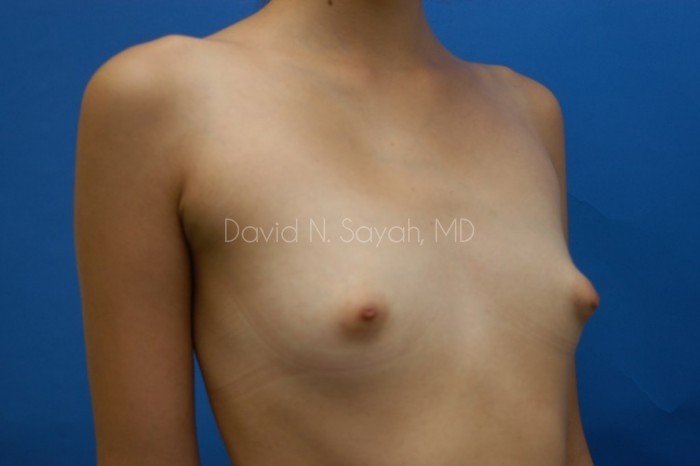 Breast Augmentation Before and After | Sayah Institute