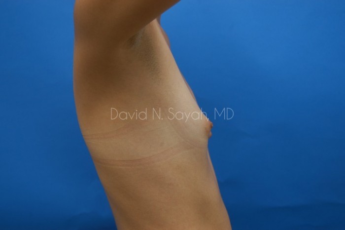 Breast Augmentation Before and After | Sayah Institute