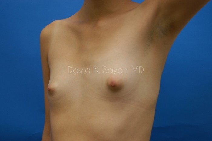 Breast Augmentation Before and After | Sayah Institute