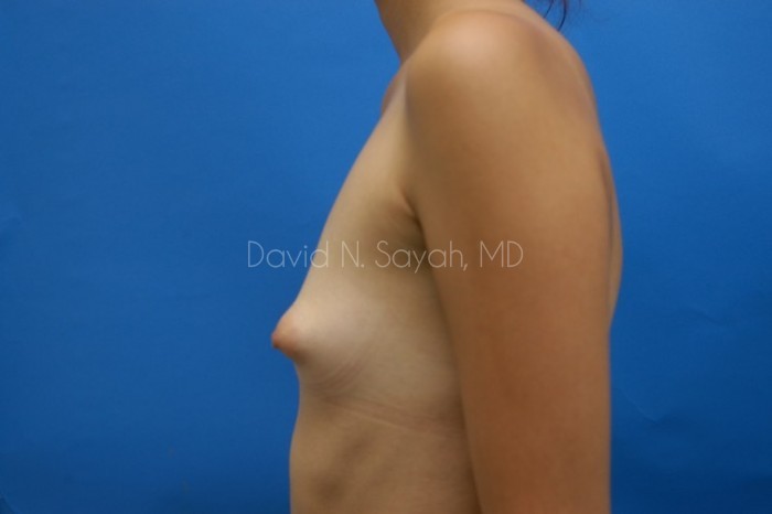 Breast Augmentation Before and After | Sayah Institute