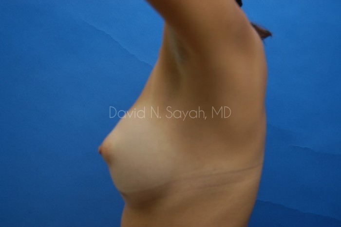 Breast Augmentation Before and After | Sayah Institute