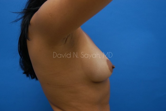 Breast Augmentation Before and After | Sayah Institute