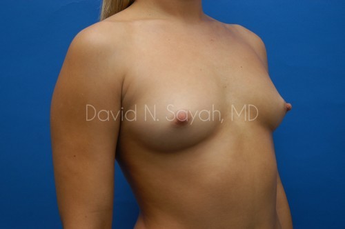 Breast Augmentation Before and After | Sayah Institute