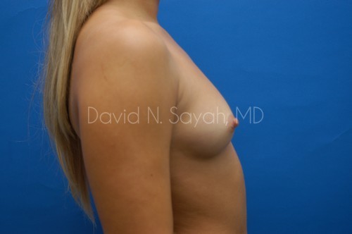 Breast Augmentation Before and After | Sayah Institute
