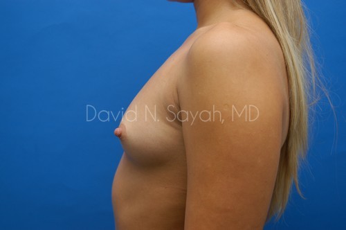 Breast Augmentation Before and After | Sayah Institute