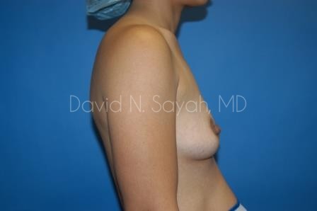 Breast Augmentation Before and After | Sayah Institute