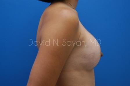 Breast Augmentation Before and After | Sayah Institute