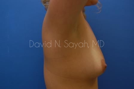 Breast Augmentation Before and After | Sayah Institute