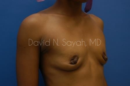 Breast Augmentation Before and After | Sayah Institute