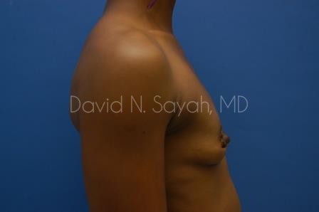 Breast Augmentation Before and After | Sayah Institute