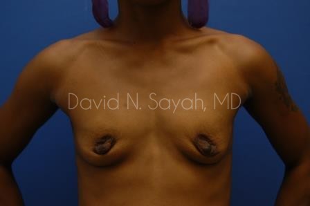 Breast Augmentation Before and After | Sayah Institute