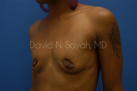 Breast Augmentation Before and After | Sayah Institute